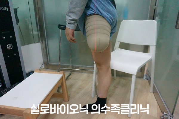 의족 제작 전 대퇴 절단 환부를 살펴보는 모습