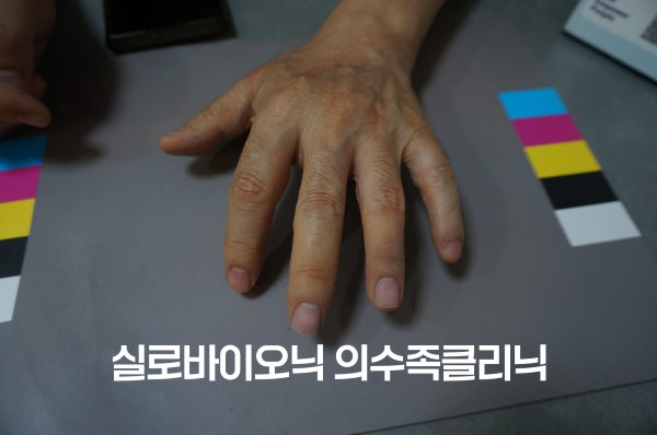 컬러차트 위에 올린 손등, 가운뎃손가락과 약지에 실리콘 미관 의수를 낀 모습