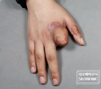 검지가 짧게 남은 손등, 흉터가 보이는 착용 전 모습