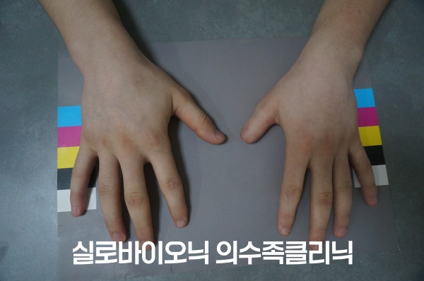 컬러차트 위에 올린 두 손등, 한쪽 엄지 끝이 짧은 착용 전 모습