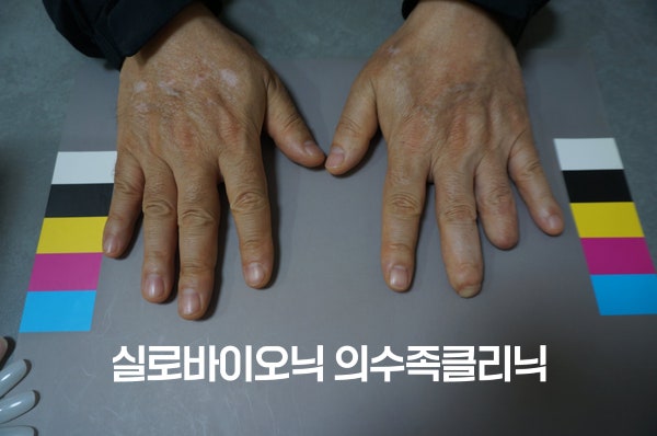 표준 컬러차트 위에 나란히 올린 두 손의 손등