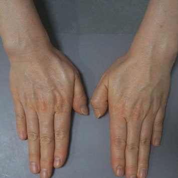 손등이 보이게 나란히 놓은 두 손, 한쪽 새끼손가락이 다른 손가락보다 짧은 착용 전 모습