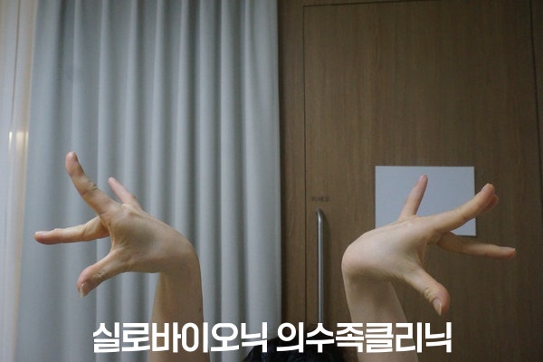 양손을 들어 손끝을 펼친 춤 동작, 의수 착용 후