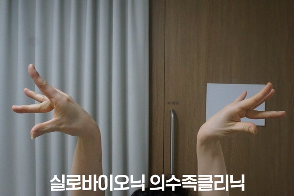 양손을 들어 손끝을 펼친 춤 동작, 의수 착용 전