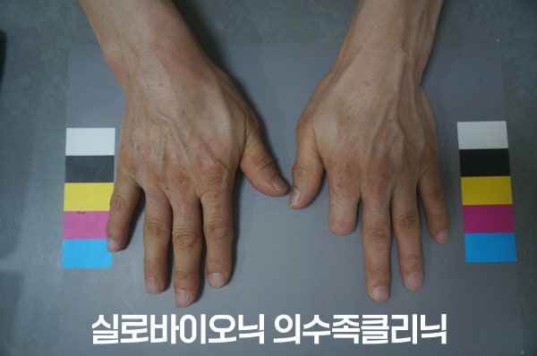 검지 의수를 착용한 손과 반대쪽 손을 컬러차트 위에 나란히 올린 모습