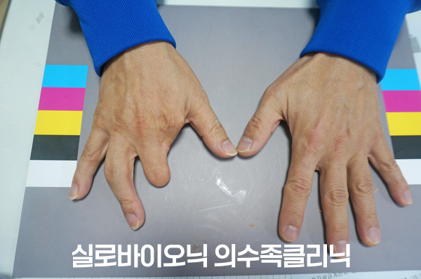 표준 컬러차트 위의 두 손, 한 손의 손가락 일부가 없는 손 부분 절단 착용 전 모습