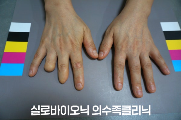 표준 컬러차트 위의 두 손, 한 손의 중지 끝마디와 약지 두 마디가 없는 착용 전 모습