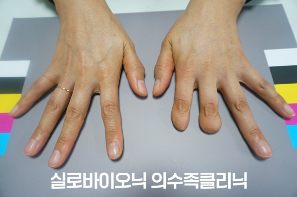 표준 컬러차트 위의 두 손, 한 손의 검지와 중지 끝마디가 없는 착용 전 모습
