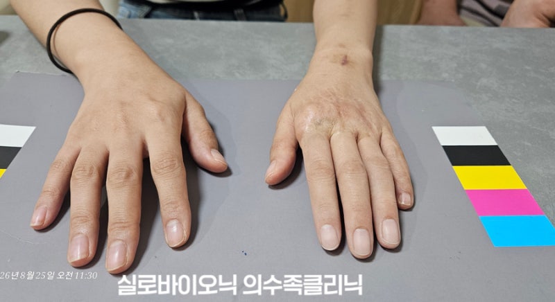 중지와 약지에 실리콘 손가락 의수를 착용하고 표준 컬러차트 위에 올린 두 손
