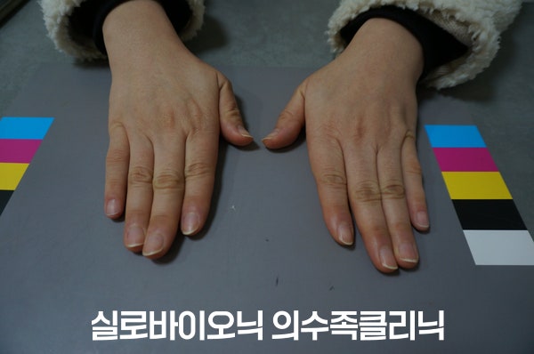 양손 새끼손가락에 실리콘 손가락 의수를 착용하고 표준 컬러차트 위에 올린 두 손