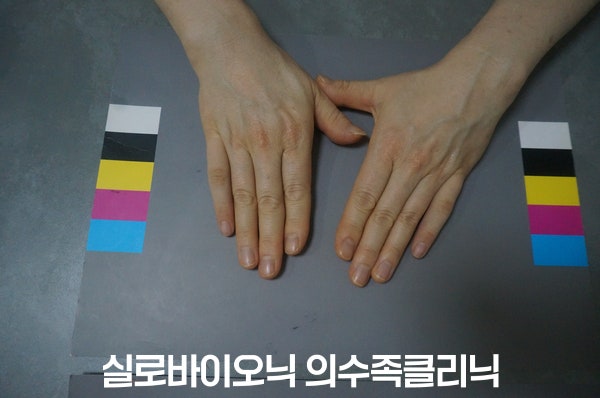 표준 컬러차트 위에 놓인 두 손, 한쪽 새끼손가락에 실리콘 손가락 의수를 착용한 모습