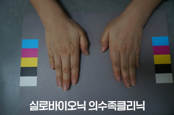 양손 새끼손가락이 다른 손가락보다 짧은 착용 전 모습