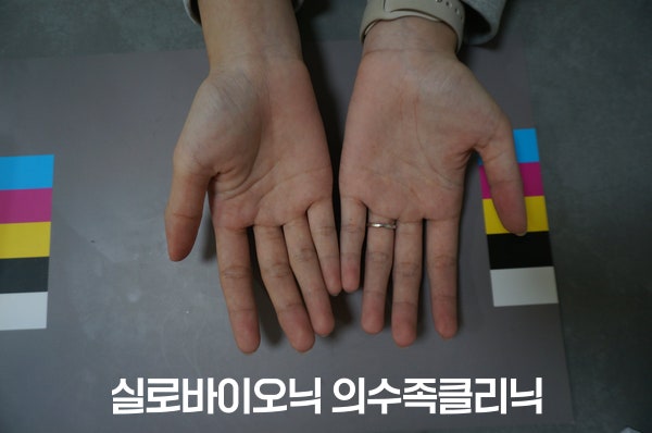 표준 컬러차트 위에 손바닥이 보이게 놓은 두 손, 한쪽 엄지에 의수를 착용한 모습