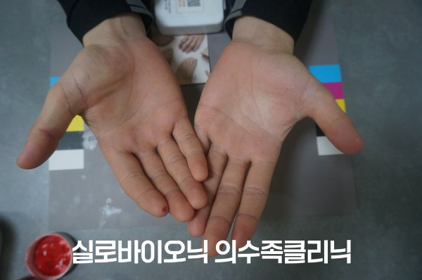 컬러차트 위에서 손바닥을 펼친 두 손, 엄지 의수 착용