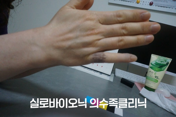체크소켓 단계에서 손가락 착용감을 확인하는 모습
