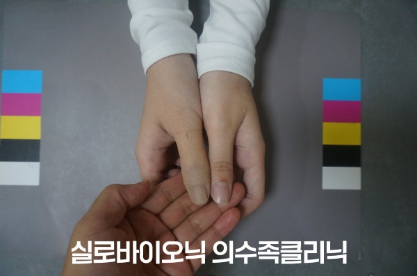 체크소켓 단계에서 가제작한 엄지 의수를 반대쪽 엄지와 나란히 비교하는 모습