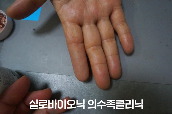 검지에 착용한 미관형 실리콘 손가락 의수, 손바닥 쪽