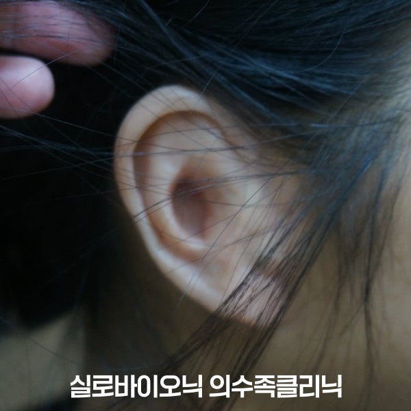 머리카락 사이로 보이는 맞춤 실리콘 귀