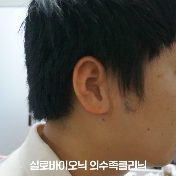 같은 고객님이 맞춤 실리콘 귀를 착용한 옆모습
