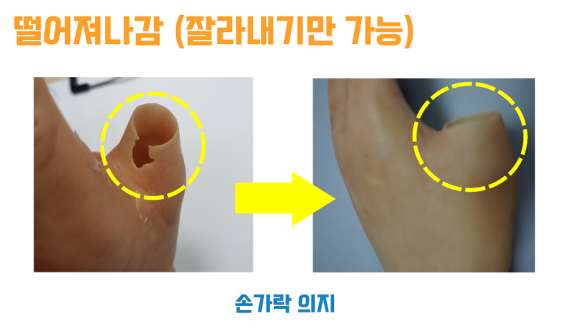 떨어져 나간 가장자리를 매끄럽게 잘라 낸 손가락 의수 전후 비교