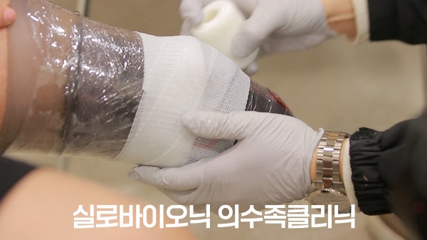 장갑을 낀 손으로 다리 환부를 본뜨는 모습