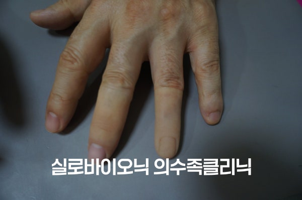 손등 쪽에서 본 손, 가운뎃손가락과 약지에 서로 다른 의수를 낀 모습