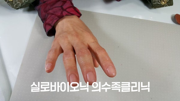 완성된 실리콘 손가락 의수를 착용한 손