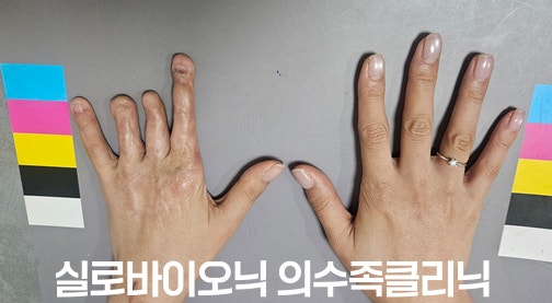 중지와 약지를 잃고 주변에 흉터와 손톱 함몰이 남은 손과 반대쪽 손
