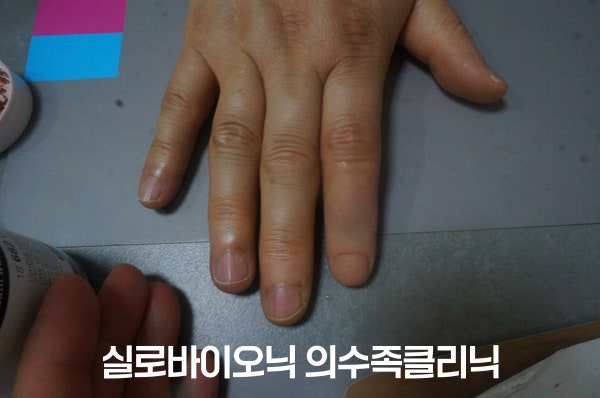 작업용 실리콘 손가락 의수를 착용한 손