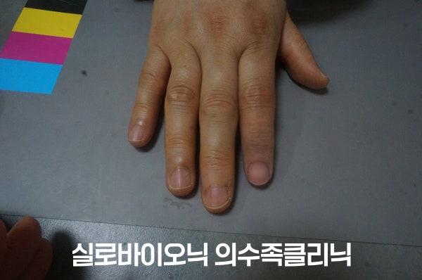 표준 컬러차트 위에 올린 손, 실리콘 손가락 의수 착용