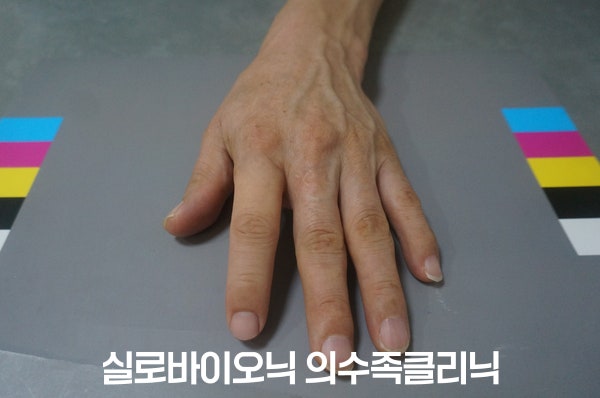 검지에 실리콘 손가락 의수를 착용하고 표준 컬러차트 위에 올린 손