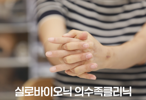실리콘 손가락 의수를 착용한 채 두 손을 맞잡은 모습