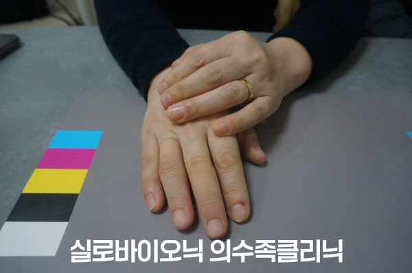 표준 컬러차트 옆에서 두 손을 겹쳐 놓은 모습, 아래 손의 중지와 약지에 실리콘 손가락 의수를 착용