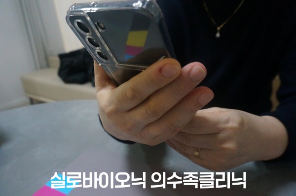 실리콘 손가락 의수를 착용한 손으로 스마트폰을 쥔 모습