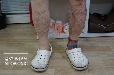 실리콘 방수커버를 씌운 의족 다리와 반대쪽 다리가 나란히 선 모습