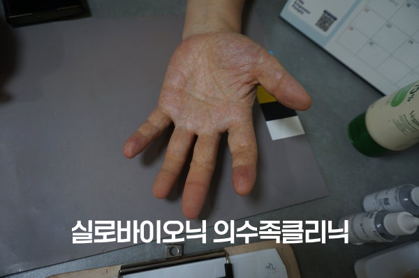 컬러차트 옆에서 손바닥을 편 손, 손가락 의수 착용