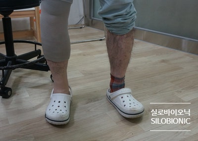 방수커버를 씌운 의족 다리와 반대쪽 다리를 뒤쪽에서 본 모습