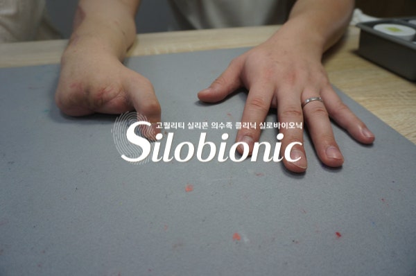 엄지만 남은 오른손과 왼손을 나란히 올린 모습