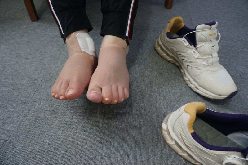의자에 앉아 한쪽 발에 실리콘 발 전체 의족을 착용한 모습