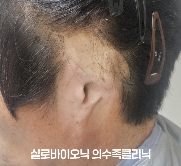 사고로 귓바퀴를 잃은 부위, 실리콘 귀 착용 전
