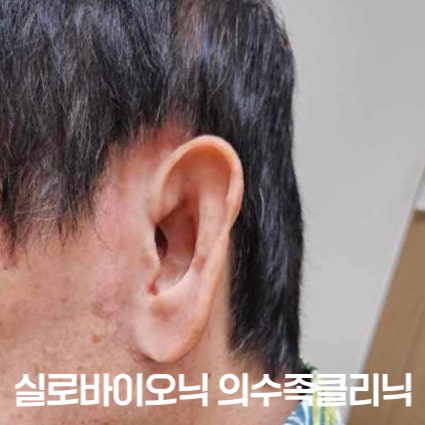 실리콘 귀 의지를 착용한 성인 고객의 옆모습