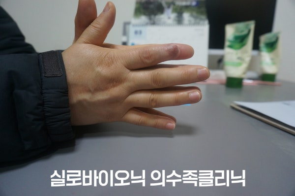 실리콘 손가락 의수를 착용한 손을 옆에서 본 모습