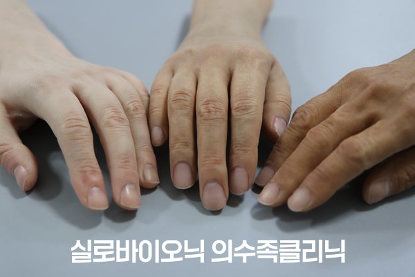 서로 다른 피부색의 손 사이에 놓인 실리콘 의수