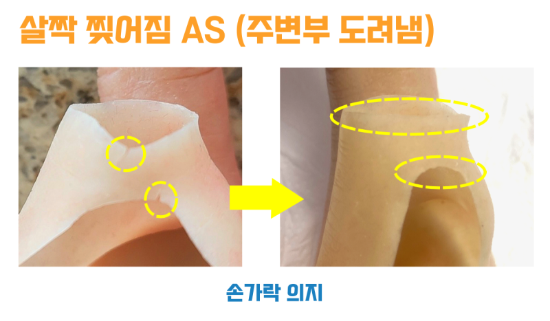 작게 찢어진 입구 둘레를 도려내 매끄럽게 정리한 손가락 의수 전후 비교