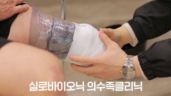 소켓 제작을 위해 전문가가 환부 본을 뜨는 모습