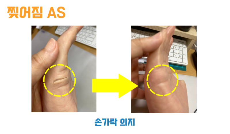 손가락 의수 옆면의 찢어진 틈과 덧대어 메운 뒤의 모습 비교