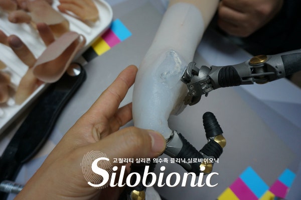 전완 소켓에 티타늄 손가락을 연결해 맞춰 보는 손