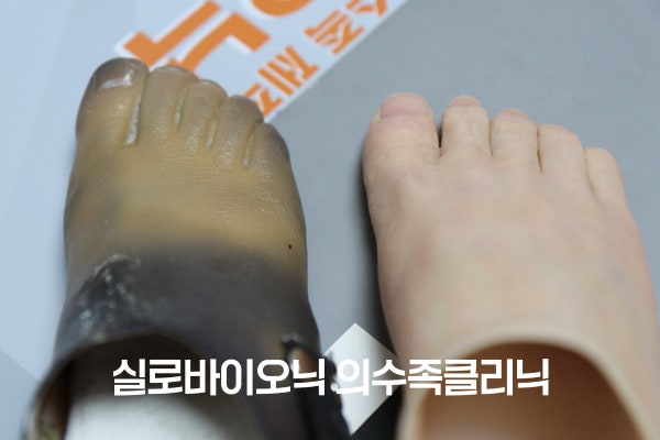 색이 짙게 변한 PVC 발 의족과 피부색에 맞춘 실리콘 발 의족의 앞부분 비교