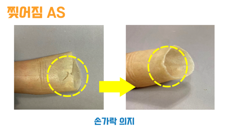 끝부분이 찢어진 실리콘 손가락 의수와 덧대어 수리한 뒤의 모습 비교