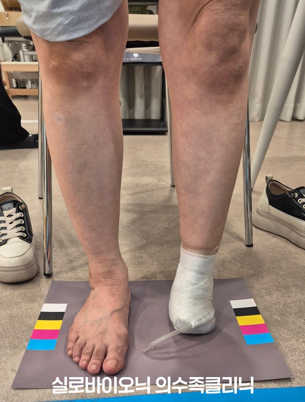 표준 컬러차트 위에 선 두 발, 발 앞부분을 잃은 쪽은 본뜨기를 위해 붕대로 감싼 모습